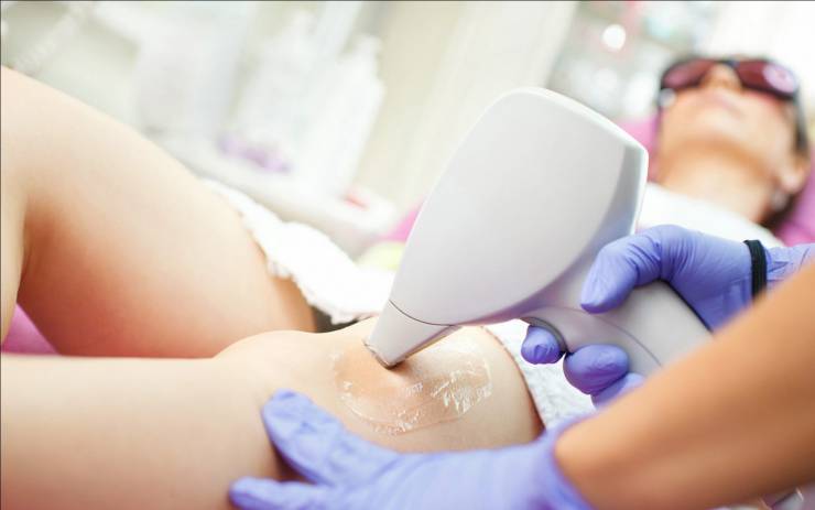 come funziona la depilazione laser